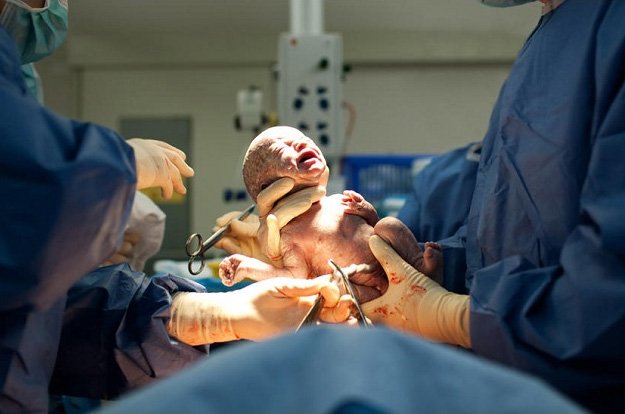 Caesarean Section